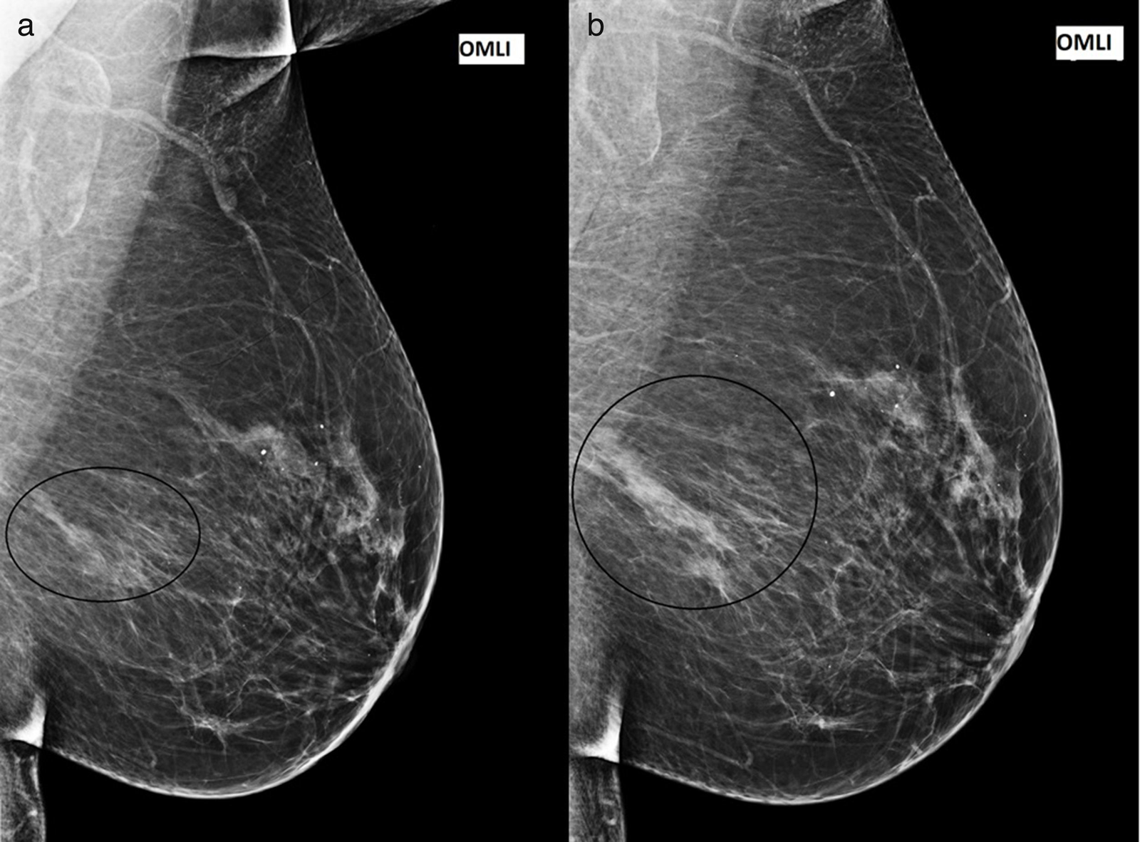 Vacuna especializada muestra los inicios de una cura para el cáncer de mama más agresivo 